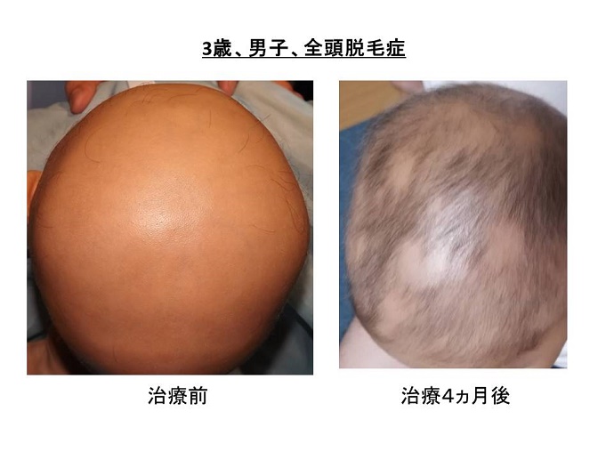 円形脱毛症　病院""